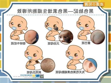 新生兒 胎記